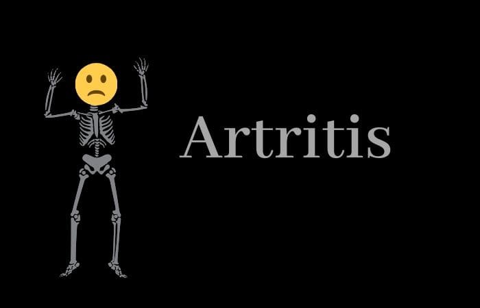 cómo saber si tengo artritis
